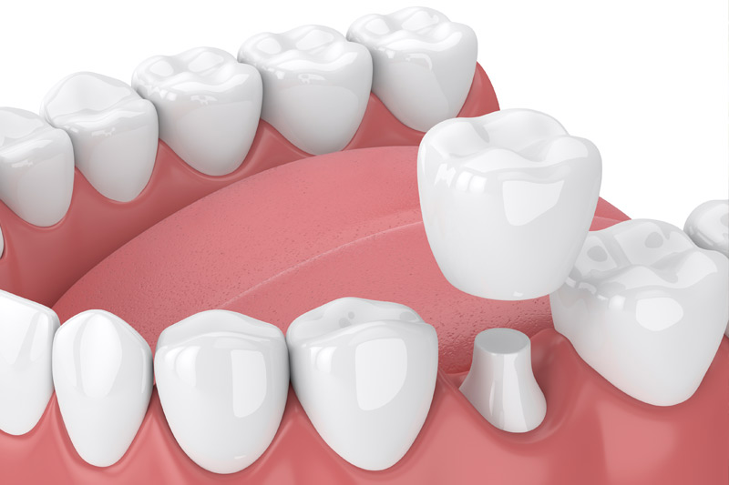 Dental Crowns in Shawnee