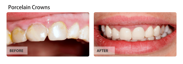 full-mouth-cosmetic-treatment